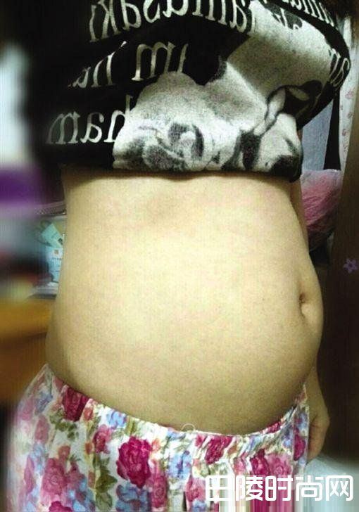腹部像5个月身孕一样