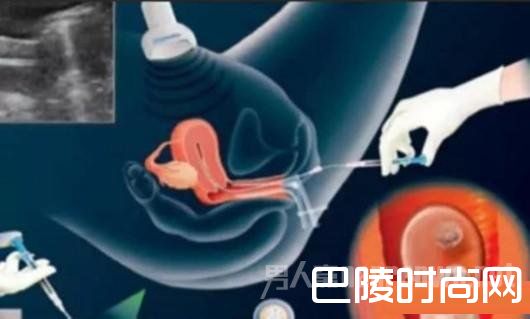 手术取卵 手术取卵