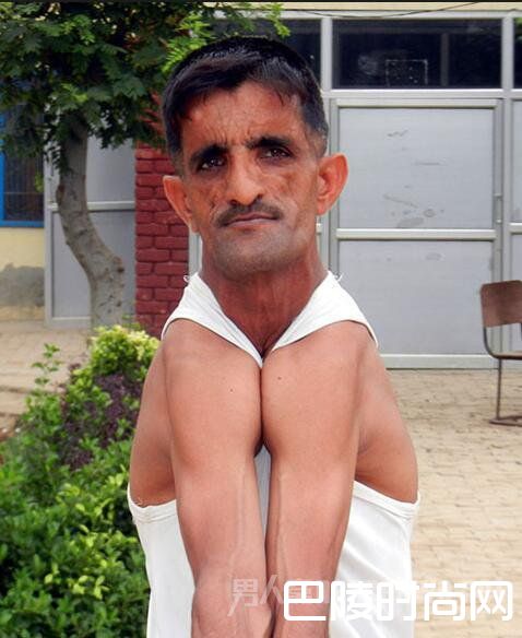 男子患病成橡皮人 男子患病成橡皮人