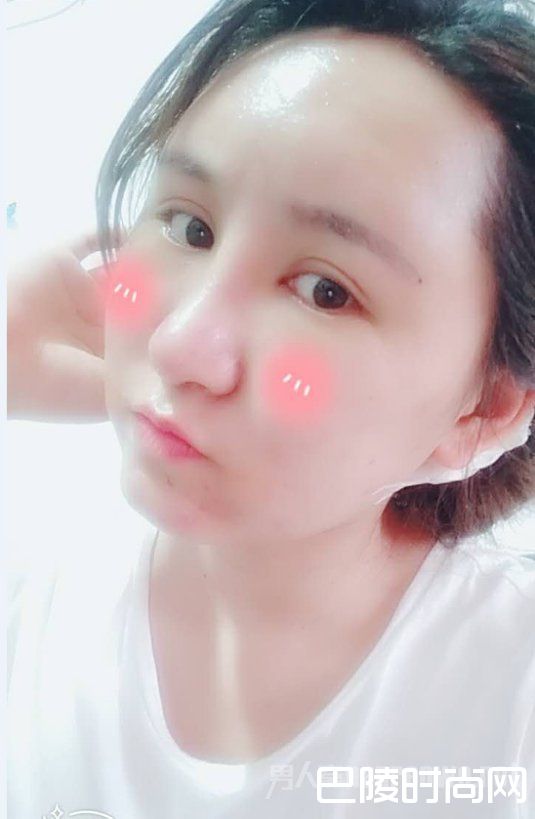 术后第七天 术后第七天