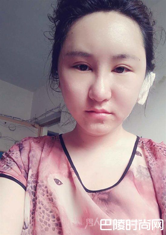 术后第三天 术后第三天