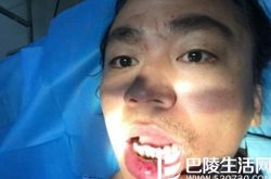 王宝强嘴缝10针让网友大呼心疼：一路走来真心不易
