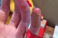 陈乔恩淤血照惹心疼 明星们淤血照个个不堪入目