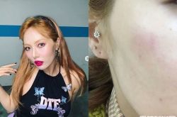 泫雅摔倒怎么回事 下舞台后紧急送医