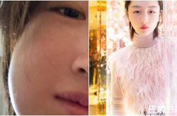 周冬雨拔智齿 脸颊肿2倍大