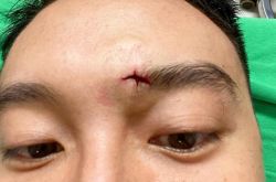 王阳明眉头十字大洞破相怎么回事