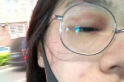 马思纯得了带状疱疹？为什么长带状疱疹