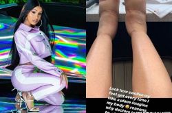 卡迪B为什么叫卡蝶B？隆胸后遗症爆脚掌比小腿粗