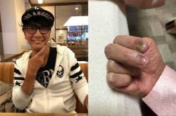 加藤鹰金手指整根黑掉怎么回事 1年后近况曝光