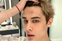 利路修录节目爆被打到骨折怎么回事