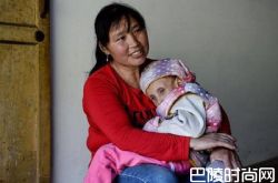 12岁拇指姑娘重20斤 少女相貌似老太太且不能站立行走令人心疼