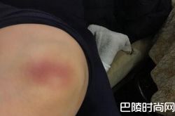 范冰冰拍戏受伤，明星拍戏受伤真是家常便饭