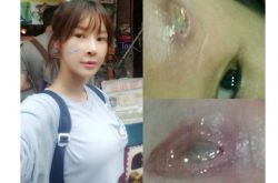 韩艺瑟整容被烧伤 Nikita也公开自己整容失败照片