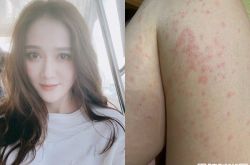 陈乔恩皮肤出状况 大腿爬满红疹崩溃