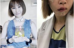 香港歌手林柏迪断牙喷血毁容 整型又肿成猪头