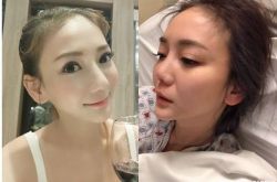 刘乔安整容鼻子垮掉 美国送急诊扎7针惊见淤血