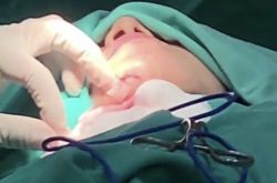 范范上厕所重心不稳摔惨 伤势照缝15针