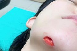 范范深夜摔伤下巴 老公黑人说开灯睡好了