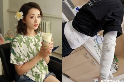 邓莎拔火罐烧伤严重吗？邓莎在哪里被烧伤