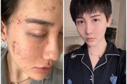 蛇精男刘梓晨消失31天突发染新冠 面部长痘哭喊毁容