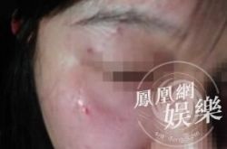 徐峥殴打女记者过程介绍 当事人晒验伤结果令人心疼