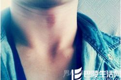 吻要人命！女子在17岁男友脖子留吻痕 致其血栓离世