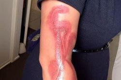 “iPhone 7烧”来也!澳孕妇睡觉被灼伤 售后否认