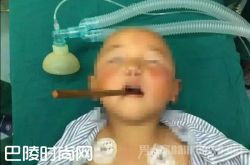 筷子插进孩子嘴里入脑4厘米 这些春节熊孩子受伤案例太惊心