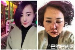 丽江被打毁容女孩公开近照：绝望中挣扎 事件全回顾