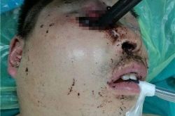 男子命悬一线！ 金属管插入男子眼部深入颅内10多厘米