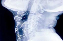 印度男子体内被插75根针 难不成是被容嬷嬷托梦扎的？