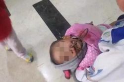 揪心！ 2岁男童玩耍不慎将剪刀插入脸部血流不止
