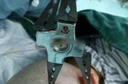 女孩遭飞镖穿透颅骨怎么回事？儿童玩具安全千万要注意