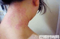 女友被男友吻过敏全身起红斑 难道是男友的口水有毒？