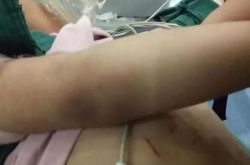 昆明3岁女童遭后妈虐待致死 头皮都被烫的寸发不生！