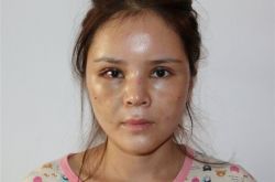 王明利博士：做自体脂肪的确会有一段肿胀期！