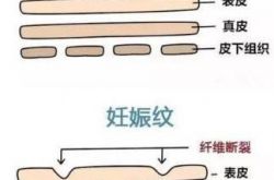 腿上妊娠纹怎样能消除，这些方法别说我没告诉你