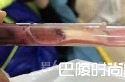 男童抽出蓝紫色血怎么回事？难道他是传说中的蓝血人？