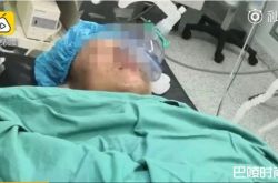 杂技演员吞剑失误 插进去真的刺穿食道