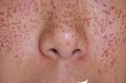 激光祛斑不留疤技术,激光祛斑术后护理很重要