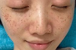 激光祛斑后遗症, 激光祛斑好不好