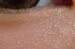 对付脂肪粒的小妙招,从生活中注意改善