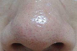 白头粉刺的危害,白头粉刺怎么祛除