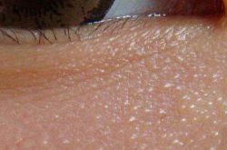 脂肪粒产生的原因,去除脂肪粒小窍门