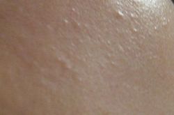 闭合性痘痘的危害,闭合性痘痘如何治疗