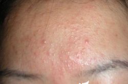 脸上长粉刺的三大原因,远离粉刺的注意细节