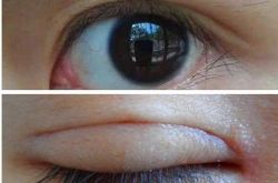 脂肪粒是怎么形成的,脂肪粒怎么去掉