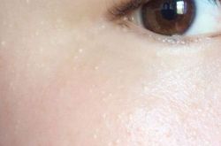 脂肪粒形成原因,脂肪粒去除方法