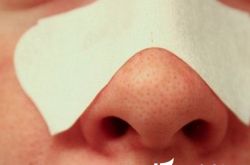 黑头的成因,去黑头缩毛孔的方法