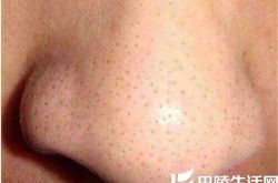鼻子毛孔大怎么办,鼻子毛孔大的原因
